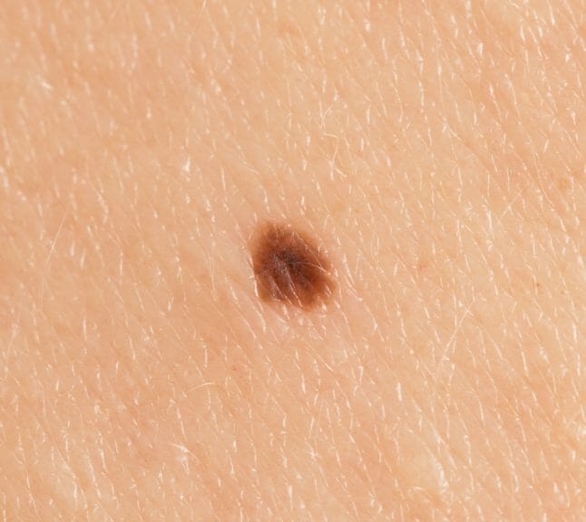 A skin mole