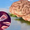 brain-eating amoeba infection