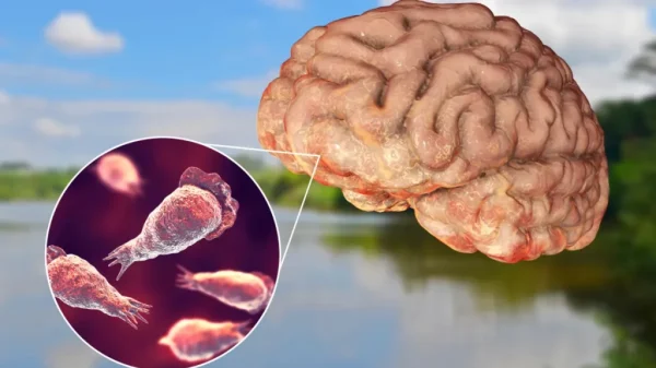 brain-eating amoeba infection