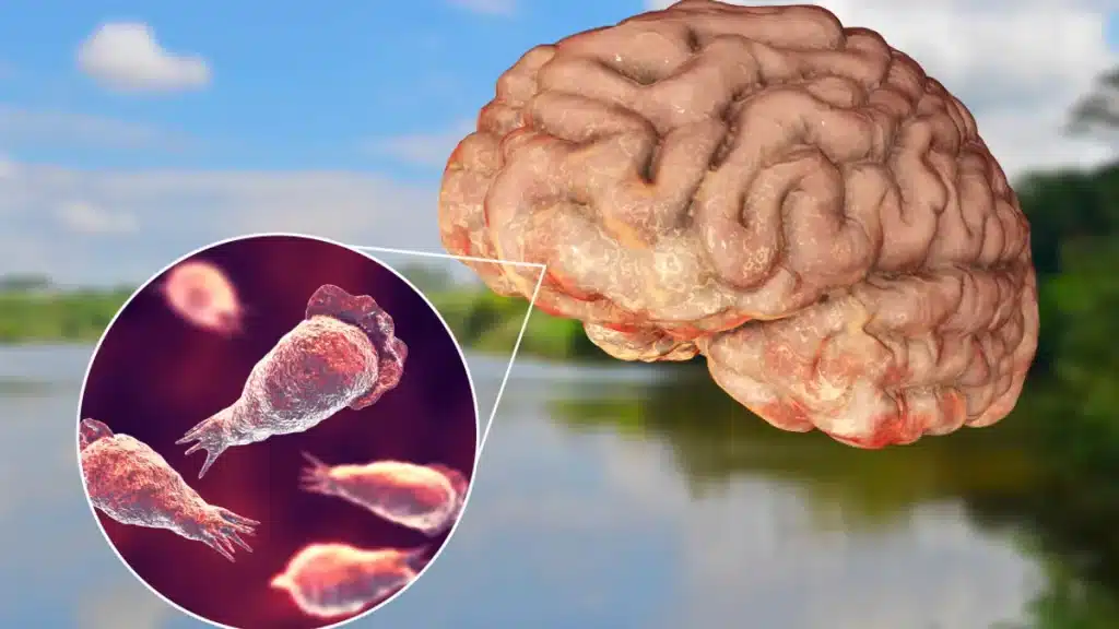 brain-eating amoeba infection