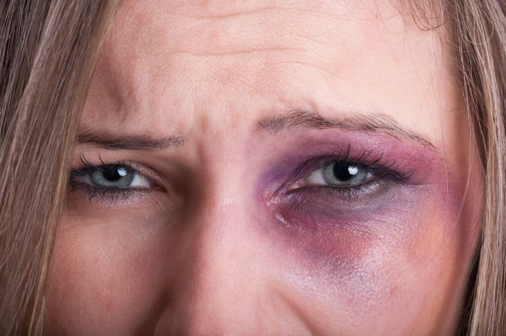 A woman with a black eye.