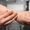 Photo of mpox on someone's arms, with a classroom in the background
