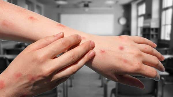 Photo of mpox on someone's arms, with a classroom in the background