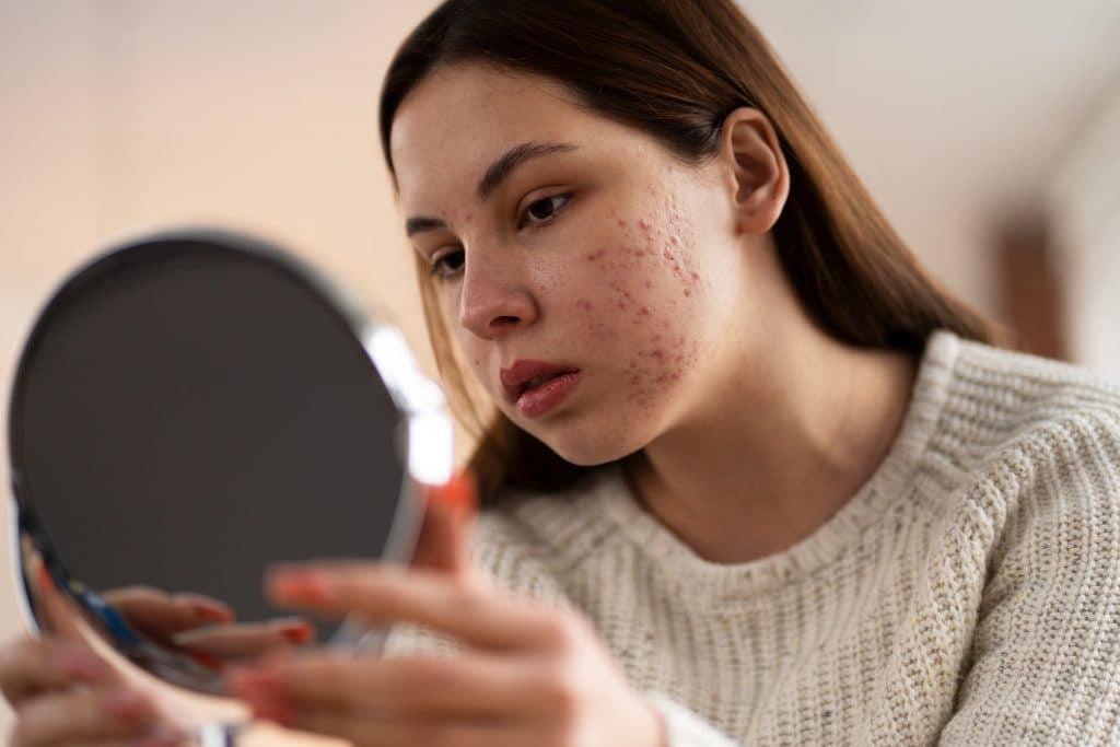 acne on face