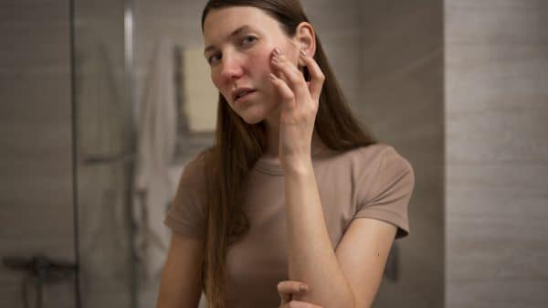 stress acne