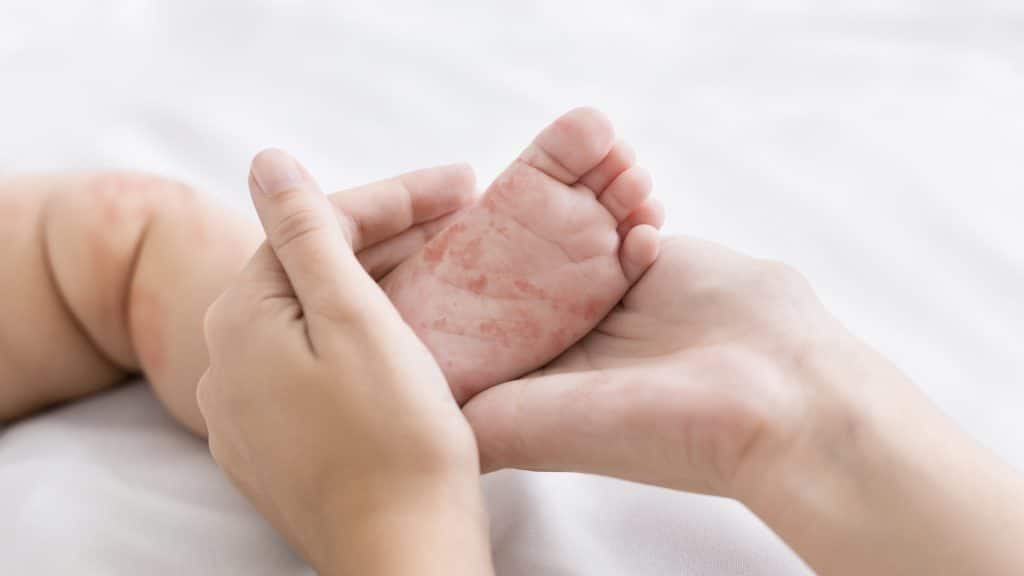 Parent holding a baby's foot with a measles rash. Image: Shutterstock/Prostock-studio