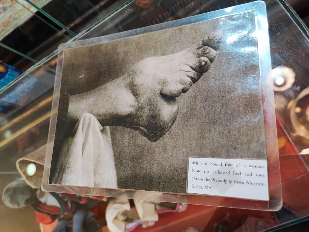 Image of a (likely elderly) Chinese woman's lotus foot, in black and white.
