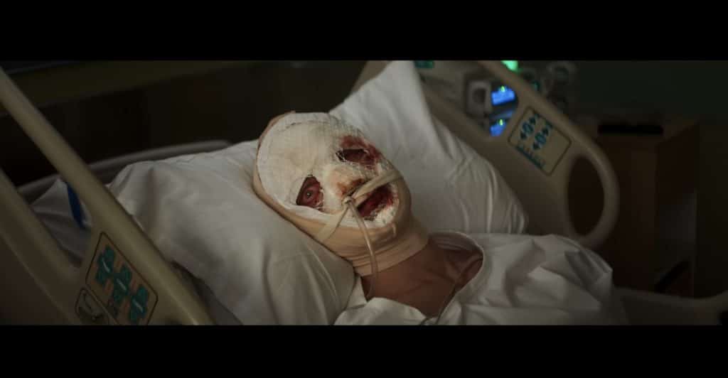 Matt Hagan (Clayface) is lying in a hospital bed with his face covered in a bandage. His eyes are watery and bloodshot.